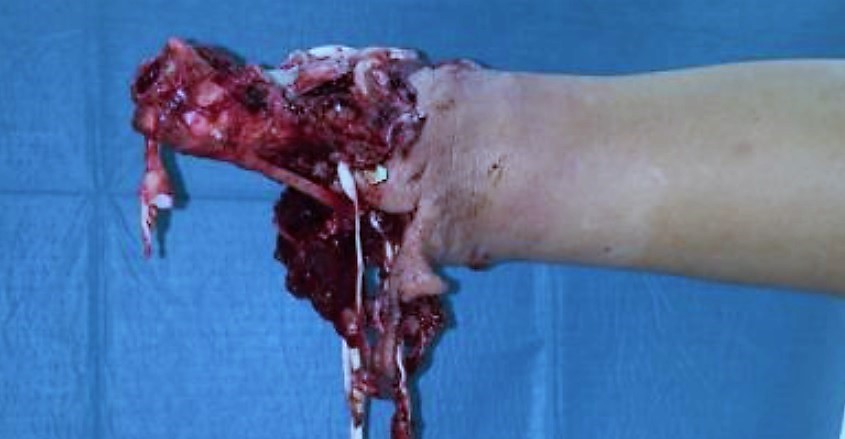 UKC_poskodba roke_pirotehnika2.jpg