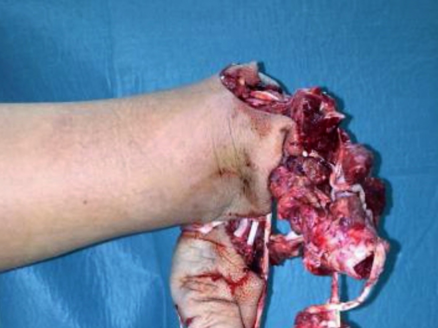 large_article_UKC_poskodbe roke_pirotehnika.jpg